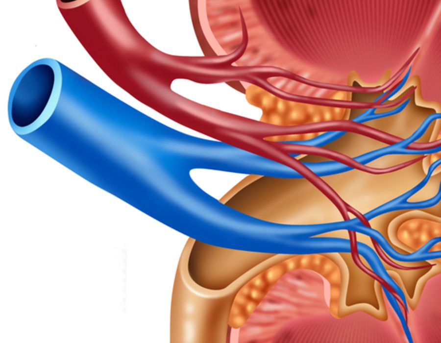Kidney Transplant