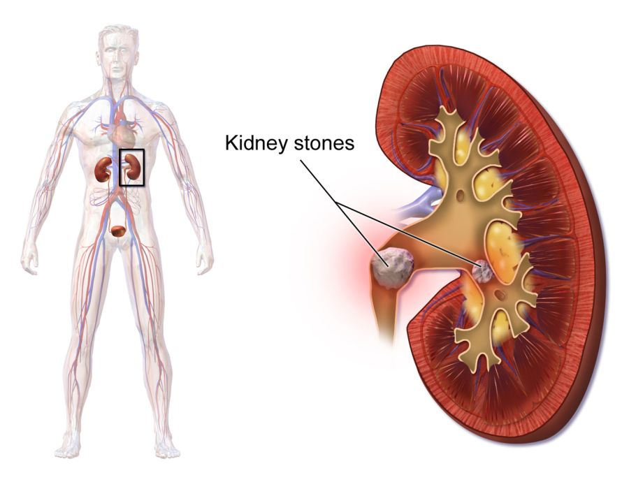 Kidney Stones